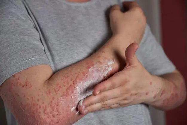 Gejala Penyakit Lupus yang Sering Diabaikan