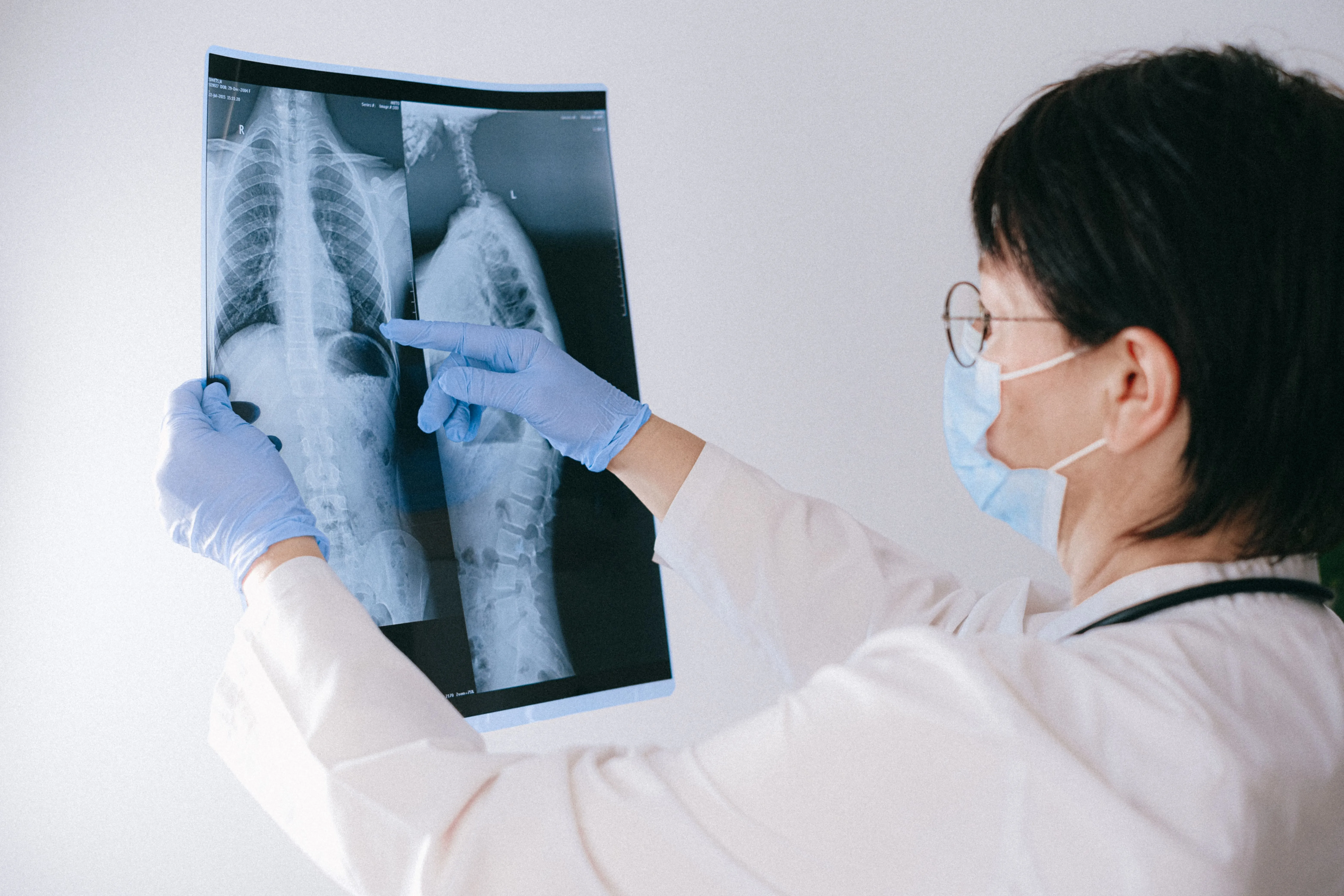 Mitos & Fakta tentang Skoliosis yang Perlu Anda Ketahui